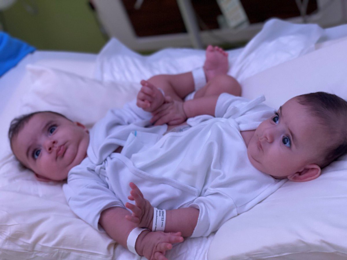 إنجاز طبي سعودي بفصل توأمين سياميين